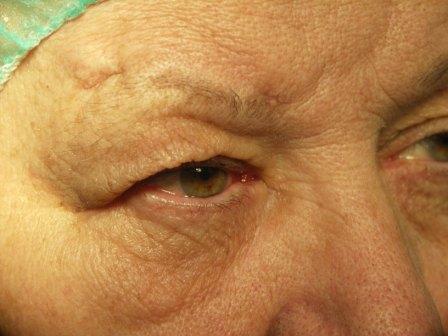 Más intézményben történt szemhéjemelő fonalműtét utáni szituáció.A beteg szemöldökét fájlalja, szemét csukni nem tudja. (szemöldöktájon fájdalmas hegesedés, felső szemhéjon bőrtúltengés)