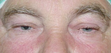 Fokozatosan kialakuló szemhéjcsüngés a szemhéjemelő izom normális működésével.