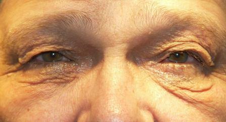 Páciensünk felső és alsó szemhéján a bőr jelentősen túlteng, felső szemhéja a súly miatt csüng. Látása korlátozott és állandósult irritatív érzete is.